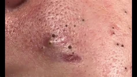 Newest Blackhead Removal Videos June 2024 - Cristy Carolina