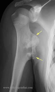 RiT radiology: Osteochondroma