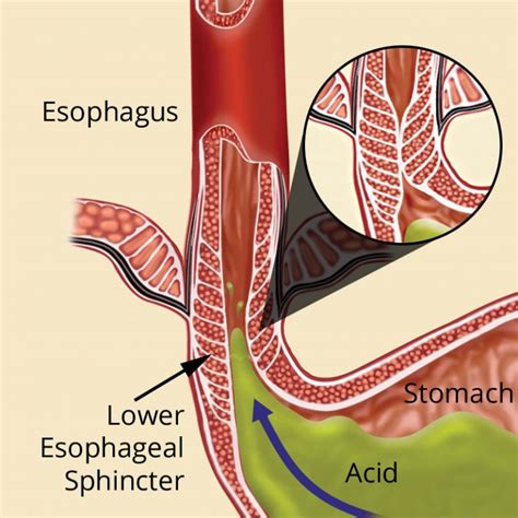 LINX System For Reflux Disease - Illinois Bariatric Center