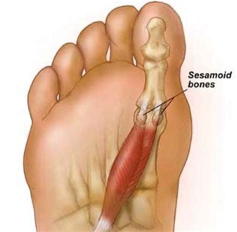 Sesamoiditis Taping