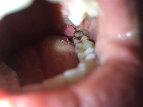 Healing process after wisdom teeth removal normal or infected?