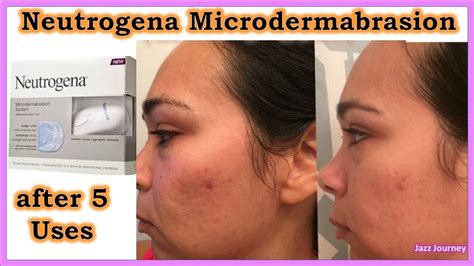 Reviews Of Neutrogena Microdermabrasion System Shop | cdlguaiba.com.br