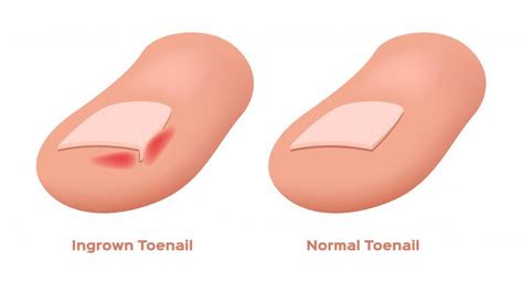 Do you suffer from an ingrown toenail?