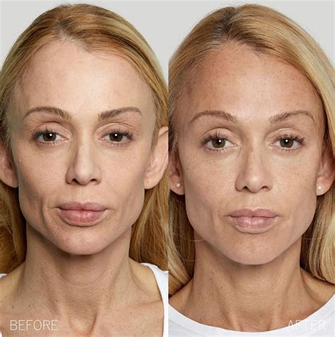 Sculptra® Archives - Torrey Pines Dermatology & Laser Center