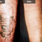 Tattoo Removal | Mclean & Woodbridge Virginia | Skin & Laser Dermatology Center