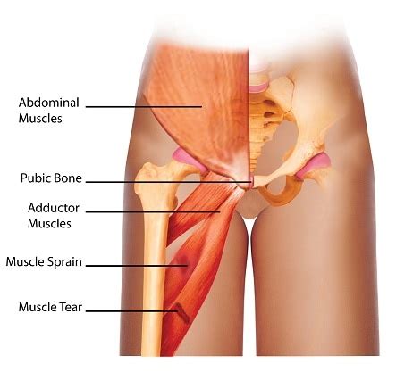 Groin Strain - Causes, Symptoms and Treatments | SportNova UK