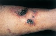 Skin necrosis with vascular calcification | Medicine Today