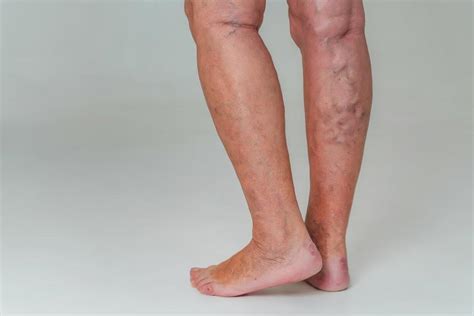 Leg Pain and Vein Disease: Understanding the Link: Prime Heart and ...