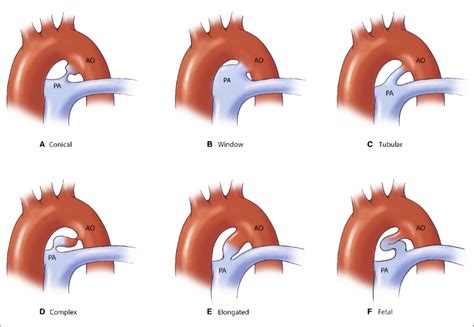 Variations in patent ductus arteriosus (PDA) configuration.... | Download Scientific Diagram