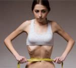 Symptoms And Treatment Of Anorexia Nervosa - Health Beauty Tips