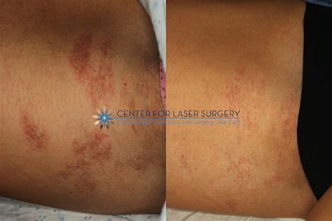 Port Wine Stain Removal | Washington, DC | Center for Laser Surgery