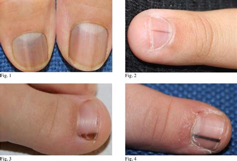 Figure 11 from Longitudinal melanonychia in childhood. | Semantic Scholar