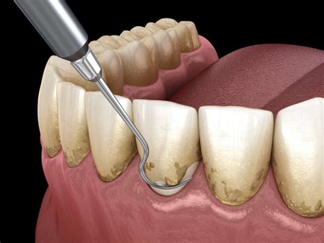 How To Remove Tartar And Plaque From Your Teeth Without A Dentist?