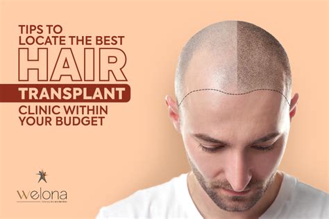 Tips to Locate the Best Hair Transplant Clinic within Your Budget