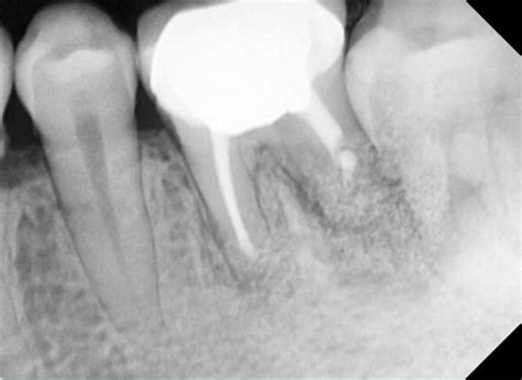 Root Canal Apicoectomy - Before & After Pictures - THE FAVOUR DENTAL - DEMO