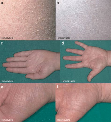 Clinical appearance of ichthyosis vulgaris. (a,c,e) Full presentation ...