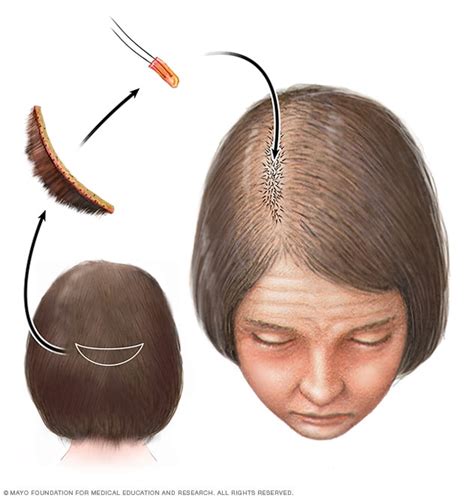 Hair loss - Diagnosis and treatment (2023)