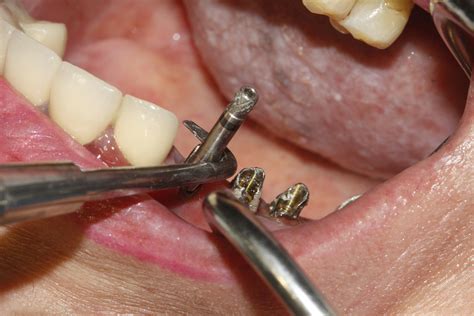 Dental Abutment