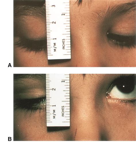 Eyelid Anatomy — Ophthalmology Review