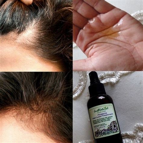 Alopecia Renewal Hair & Scalp Therapy | Hair treatment, Hair loss treatment, Alopecia hair loss ...