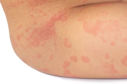 Hives Skin Rashes Itchy