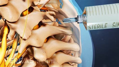 Cervical Epidural Steroid Injections Can Bring Neck and Arm Pain Relief