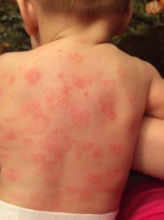 Heat rash or eczema? | BabyCenter