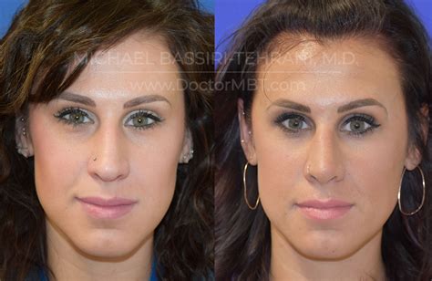 Photo Gallery - Facial Plastic Surgery Before and After - Dr. MBT