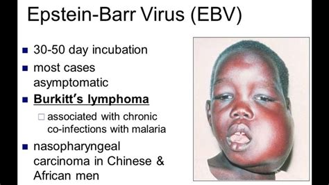 What Is Burkitt's Lymphoma