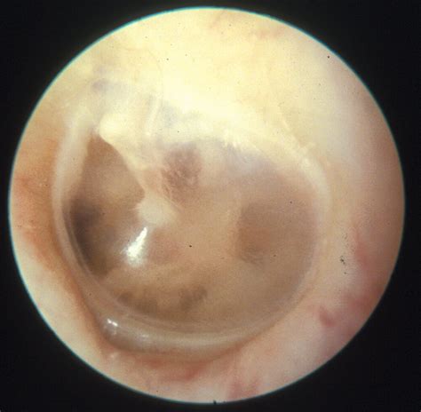 Acute otitis media — entsho.com