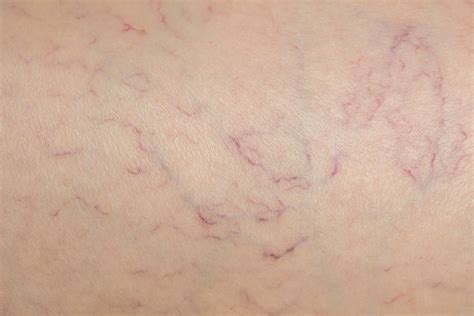 Spider Veins: Why they Appear and How to Treat Them - Este