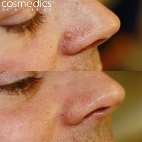 Mole Removal Clinics London & Bristol | Cosmedics Skin Clinics