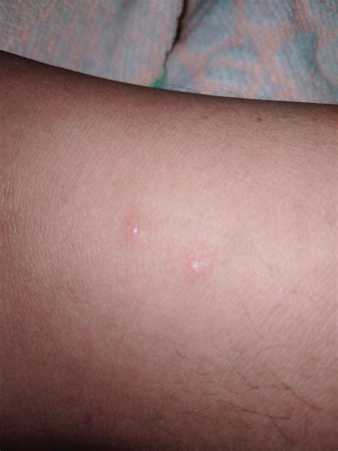 Are these bat bites? I woke up with these but it is not as swollen up, it was really itchy. I ...