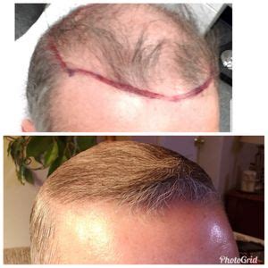 LEONARD HAIR TRANSPLANT ASSOCIATES - 300 Centerville Rd, Warwick, Rhode Island - Hair Loss ...