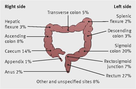 Colorectal adenocarcinoma: risks, prevention and diagnosis | The BMJ