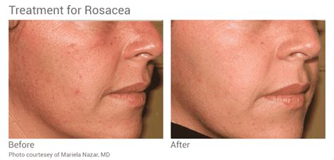 Vascular Rosacea - Well Medical Arts: Seattle's Anti-Aging Clinic