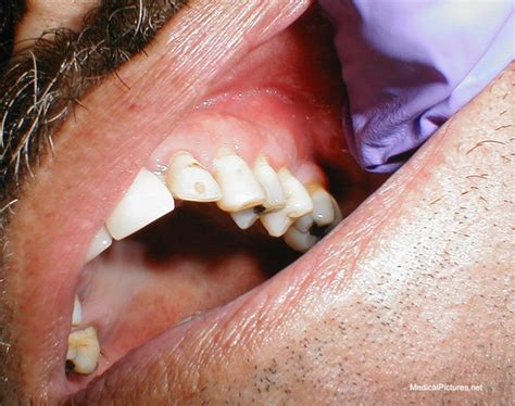 Tooth Abscess Pictures