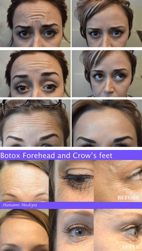 Botox For Forehead - Fort Worth , TX: Hanami Medspa