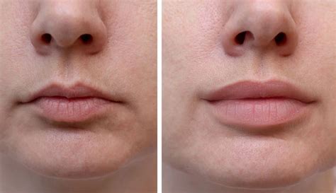 The Amazing Transformation of Lip Injections Before and After - Trends ...