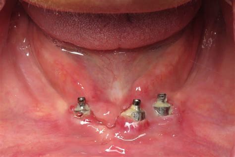All-On-4 Dental Implant Problems And Complications (2022)