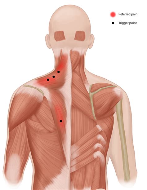 Trigger Point Injection | Myofascial Pain Treatment | Pain Spa, Bristol, UK