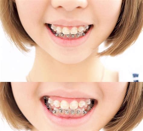 My Braces Story #2: Put on Braces, Damon Braces System , Price & My Experience | Chanwon.com ...