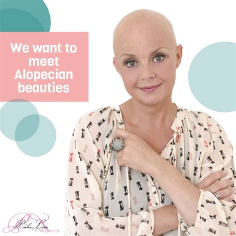 “We want to meet Alopecian beauties”- Unfortunately, anyone can suffer from Alopecia. If you are ...