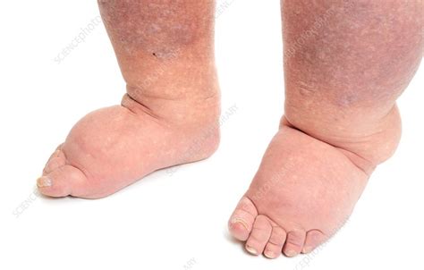 Lymphoedema in the feet - Stock Image - C014/2466 - Science Photo Library