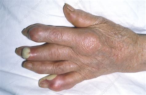 Gout - Stock Image - M165/0242 - Science Photo Library