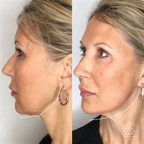 Jawline Enhancement Vancouver, BC | Jawline Treatment By Skin Technique