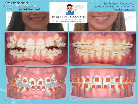 Custom Braces Light Force Before and After 6 Months Progress - Passamano Orthodontics