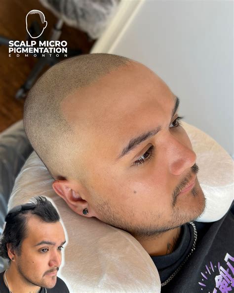 BEFORE & AFTER | Scalp Micropigmentation Edmonton