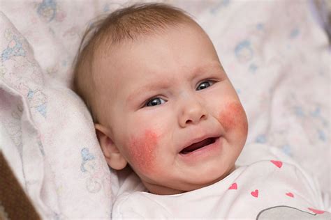 5 Types Of Skin Allergies In Babies, Treatment & Prevention