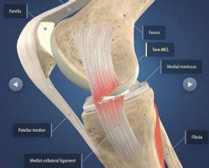 The Do's and Don'ts After ACL & MCL Tears & Surgery | Heiden Orthopedics